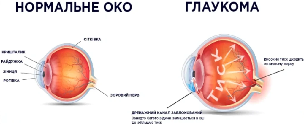 Глаукома